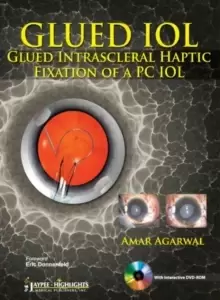Image of GLUED IOL : Glued Intrascleral Haptic Fixation of a PC IOL