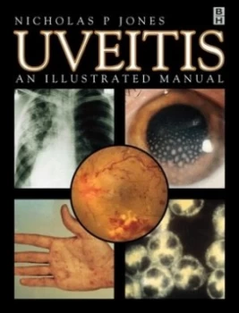 Image of Uveitis by Nicholas Jones Paperback