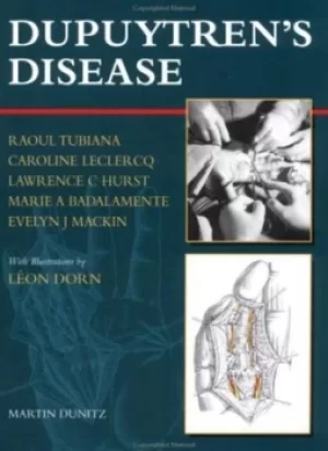 Image of Dupuytrens disease by Marie A Badalmente