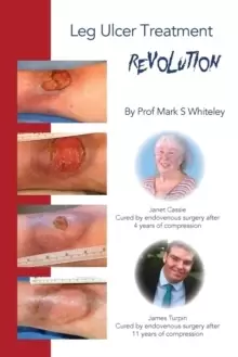 Image of Leg Ulcer Treatment Revolution
