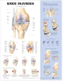 Image of Knee Injuries Anatomical Chart
