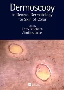 Image of Dermoscopy in General Dermatology for Skin of Color