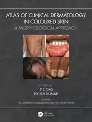 Image of Atlas of Clinical Dermatology in Coloured Skin A Morphological Approach