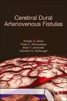 Image of Cerebral Dural Arteriovenous Fistulas by Bradley A. Gross