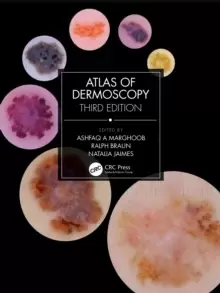 Image of Atlas of Dermoscopy : Third Edition