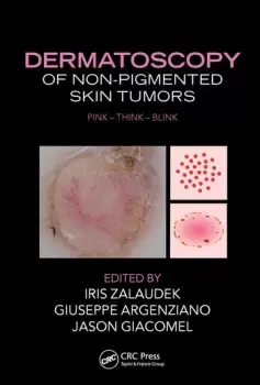 Image of Dermatoscopy of Non-Pigmented Skin TumorsPink - Think - Blink