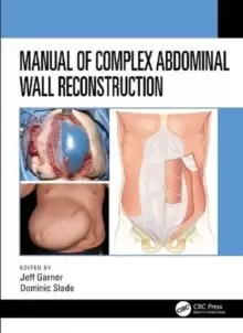 Image of Manual of Complex Abdominal Wall Reconstruction