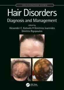 Image of Hair Disorders : Diagnosis and Management