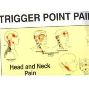Image of Trigger Point Pain Patterns Wall Charts by David G. Simons, Janet G. Travell (Fold-out book or chart, 1994)
