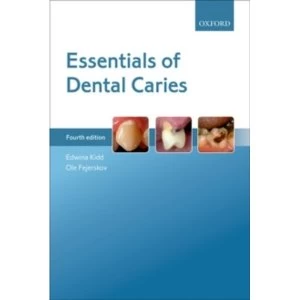 Image of Essentials of Dental Caries