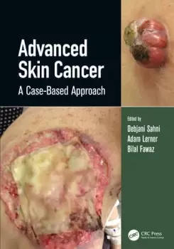 Image of Advanced Skin Cancer A Case-Based Approach