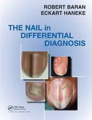 Image of Nail in Differential Diagnosis