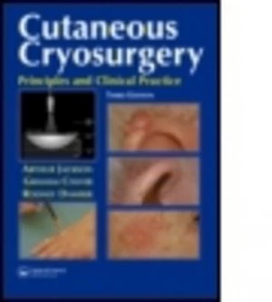 Image of Cutaneous Cryosurgery by Graham B. Colver Hardback