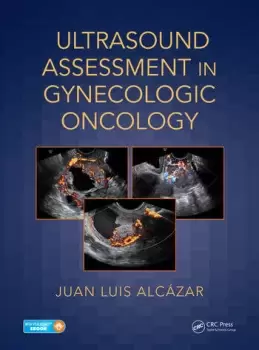 Image of Ultrasound Assessment in Gynecologic Oncology